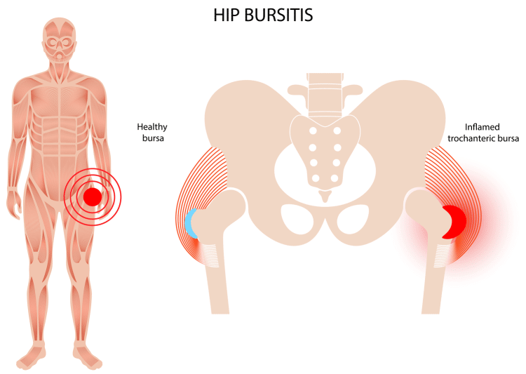 Bursitis Inflammation