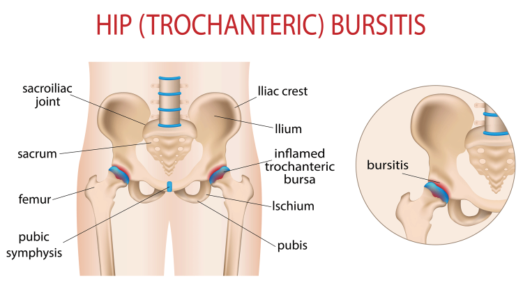 Hip Pain Bursitis