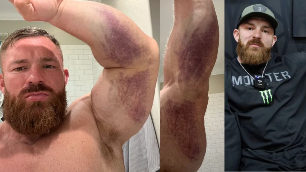 Flex Lewis Talks Injury