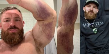 Flex Lewis Talks Injury