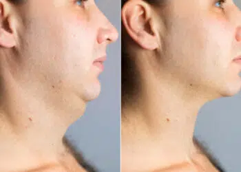 Chiseled Jawline Exercises