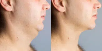 Chiseled Jawline Exercises