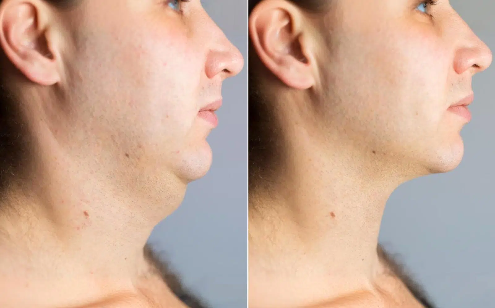 Chiseled Jawline Exercises