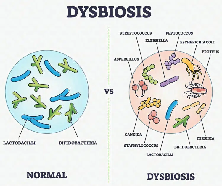 Gut Dysbiosis