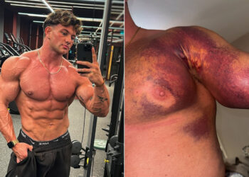 Tristan Barnes Pec Tear