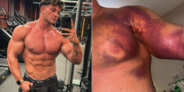 Tristan Barnes Pec Tear