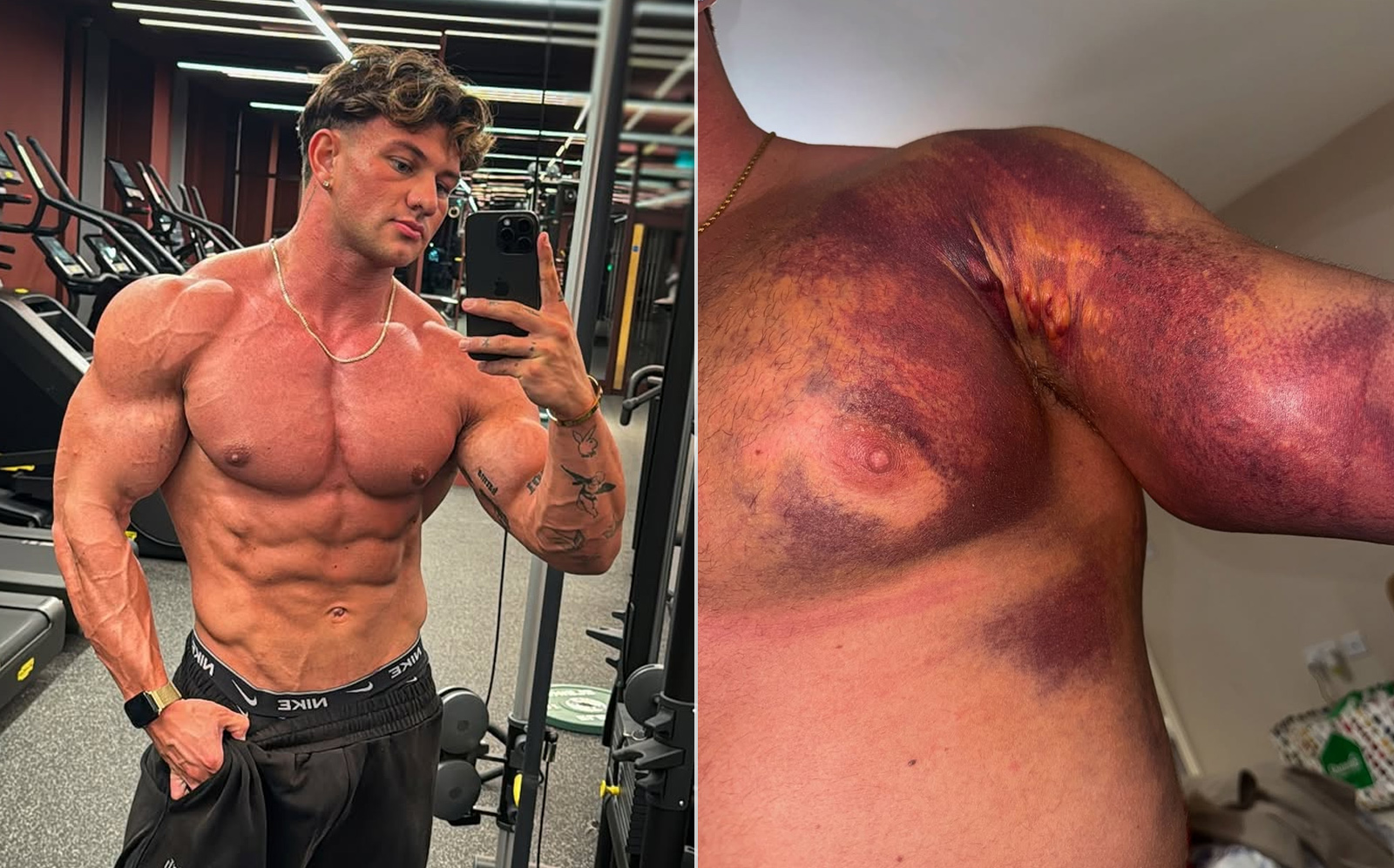 Tristan Barnes Pec Tear