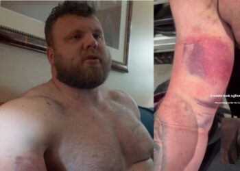 Tom Stoltman Reveals Bicep Injury After 2025 Strongest Man On Earth