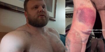 Tom Stoltman Reveals Bicep Injury After 2025 Strongest Man On Earth