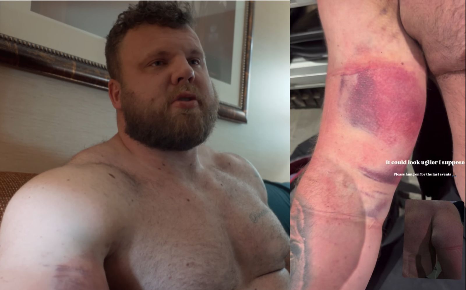 Tom Stoltman Reveals Bicep Injury After 2025 Strongest Man On Earth