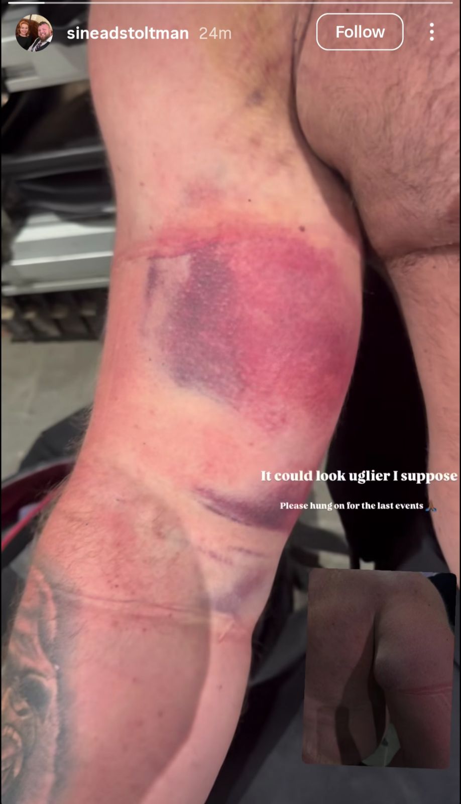 Tom Stoltman S Bicep Injury